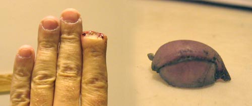 Severed Fingertip